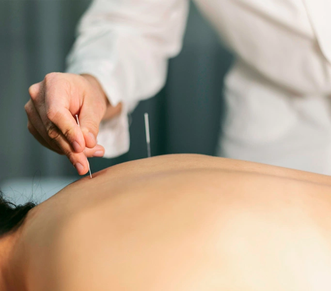 Acupuntura terapeutica en teramedic