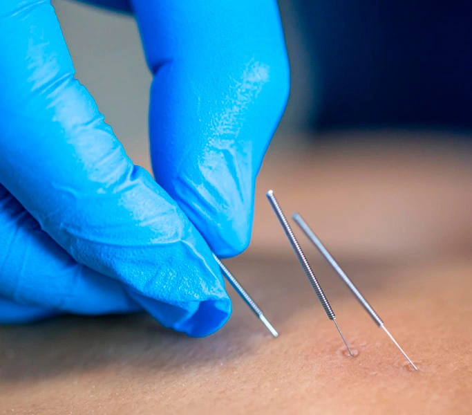 Punción seca en TeraMedic